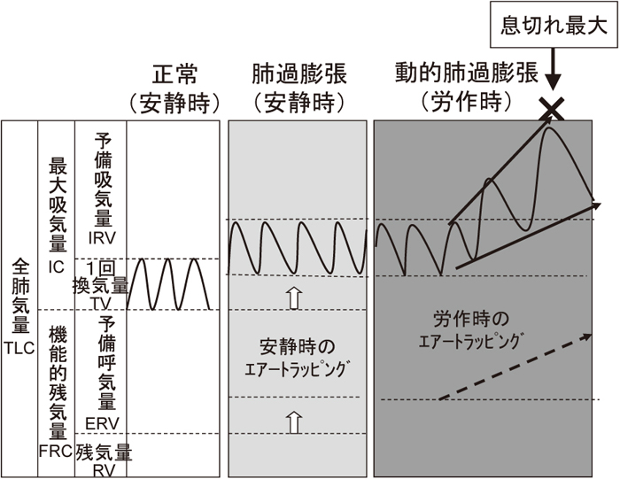 慢性閉塞性肺疾患でどのように息切れが起こるか はるのひぐらし